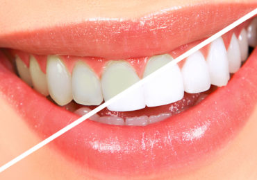 Teeth-Whitening
